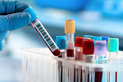 Das große Blutbild verstehen – das bedeuten die Blutwerte