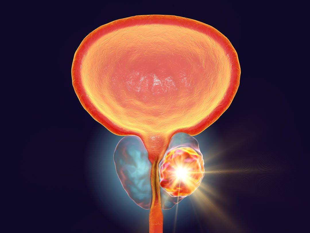 Prostatahyperplasie: Das passiert bei einer Prostatavergrößerung